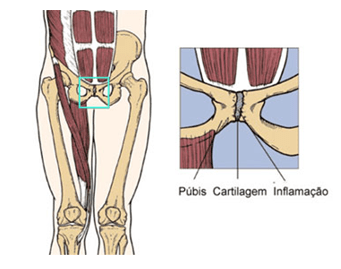 191200915153pubalgia